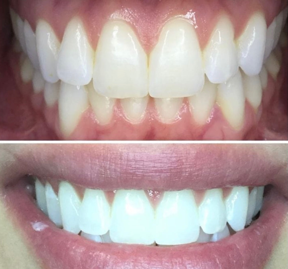 Teeth Smile Gel Strips at Home Safe Use(28 Strips)