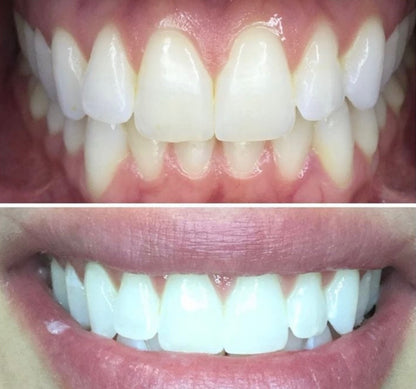 Teeth Smile Gel Strips at Home Safe Use(28 Strips)